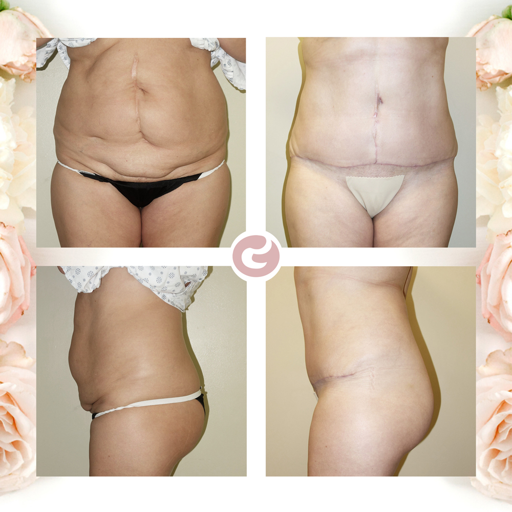 Abdominoplasty / Tummy Tuck Before and After Photos Vancouver, British  Columbia, CA