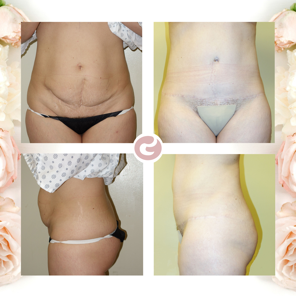 Tummy Tuck Fall River MA  Abdominoplasty to Tone Your Stomach