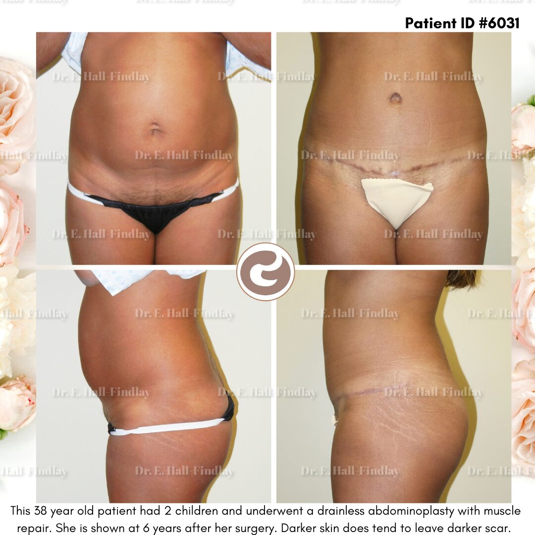 Before and after images reflecting a patient’s abdominoplasty experience at Banff Plastic Surgery.